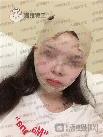 四川友谊张立天颧骨磨骨术案例价格分享,术后十天详介是一种什么体验?