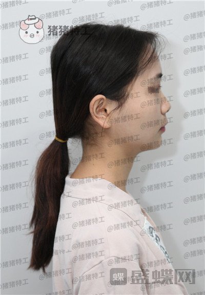 重庆铂生杜亚旭隆鼻案例价格分享,逛街被要签名以为我是某某明星~