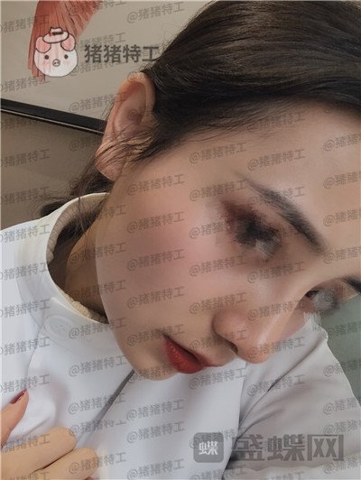重庆铂生杜亚旭隆鼻案例价格分享,逛街被要签名以为我是某某明星~