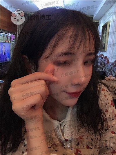 重庆铂生杜亚旭隆鼻案例价格分享,逛街被要签名以为我是某某明星~
