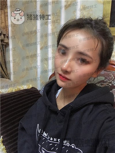 重庆铂生杜亚旭隆鼻案例价格分享,逛街被要签名以为我是某某明星~