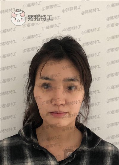 上海愉悦美联臣陈红梅面部填充案例价格分享,脸上饱满年轻御姐范儿轻松掌握~