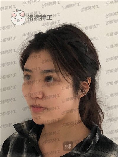 上海愉悦美联臣陈红梅面部填充案例价格分享,脸上饱满年轻御姐范儿轻松掌握~