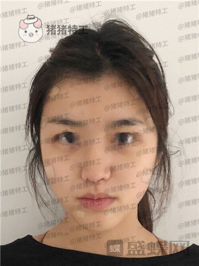 上海愉悦美联臣陈红梅面部填充案例价格分享,脸上饱满年轻御姐范儿轻松掌握~