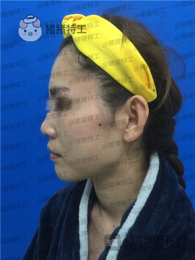 福州星龄黎护忠面部填充案例价格分享,朋友都说我像娜扎仙女太开心了!
