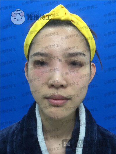 福州星龄黎护忠面部填充案例价格分享,朋友都说我像娜扎仙女太开心了!