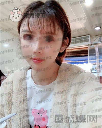 福州星龄黎护忠面部填充案例价格分享,朋友都说我像娜扎仙女太开心了!