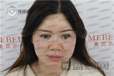 贵阳美贝尔宋俊辉鼻部手术案例价格分享,老阿姨逆袭谈恋爱变美两不误~