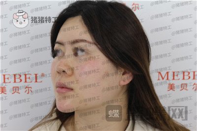 贵阳美贝尔宋俊辉鼻部手术案例价格分享,老阿姨逆袭谈恋爱变美两不误~