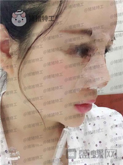 贵阳美贝尔宋俊辉鼻部手术案例价格分享,老阿姨逆袭谈恋爱变美两不误~