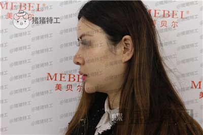 贵阳美贝尔宋俊辉鼻部手术案例价格分享,老阿姨逆袭谈恋爱变美两不误~
