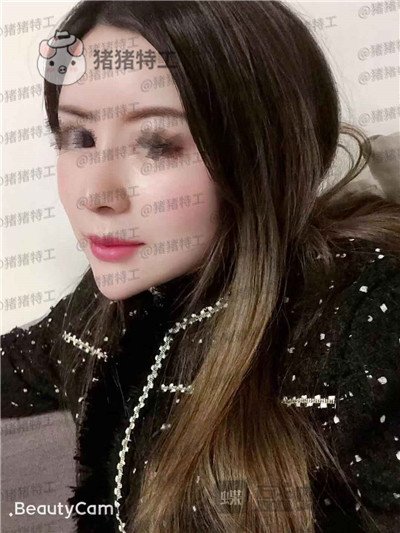 贵阳美贝尔宋俊辉鼻部手术案例价格分享,老阿姨逆袭谈恋爱变美两不误~