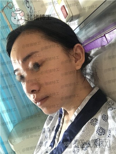 广州美莱张毓面部填充案例价格分享,曾经显凶的脸现在都夸我萌萌哒可爱~