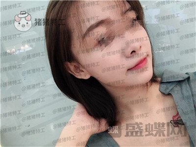 广州美莱张毓面部填充案例价格分享,曾经显凶的脸现在都夸我萌萌哒可爱~