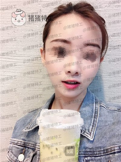 广州美莱张毓面部填充案例价格分享,曾经显凶的脸现在都夸我萌萌哒可爱~