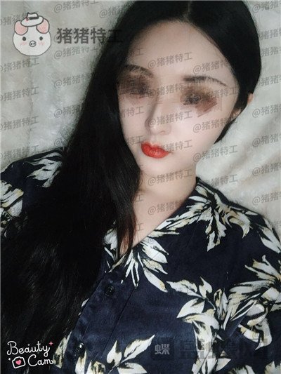 成都格莱丽王伟面部填充案例价格分享,自体脂肪竟然有美肤的作用皮肤变得很好!
