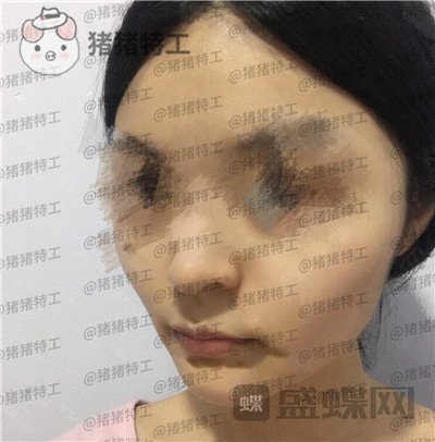 成都格莱丽王伟面部填充案例价格分享,自体脂肪竟然有美肤的作用皮肤变得很好!