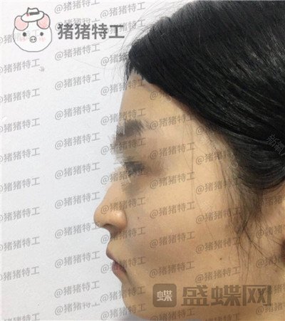 成都格莱丽王伟面部填充案例价格分享,自体脂肪竟然有美肤的作用皮肤变得很好!