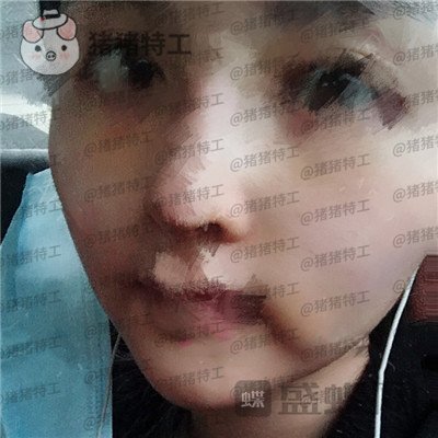 成都格莱丽王伟面部填充案例价格分享,自体脂肪竟然有美肤的作用皮肤变得很好!