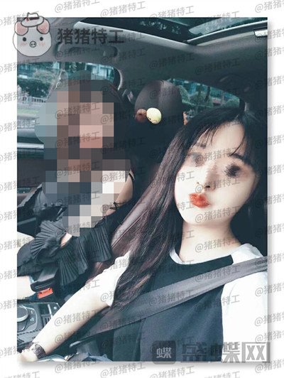 成都格莱丽王伟面部填充案例价格分享,自体脂肪竟然有美肤的作用皮肤变得很好!