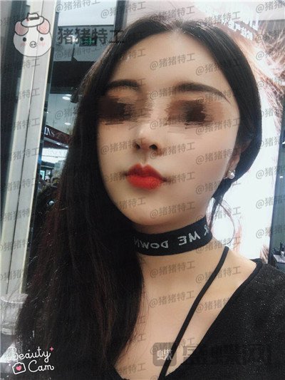 成都格莱丽王伟面部填充案例价格分享,自体脂肪竟然有美肤的作用皮肤变得很好!