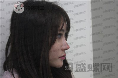 成都西区医院肖凌鼻部手术案例价格分享,恕我直言这是混血吗完全看不出是国人~