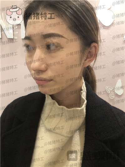 青岛诺德姜留刚面部填充案例价格分享,朋友认不出以为我是新来的模特?