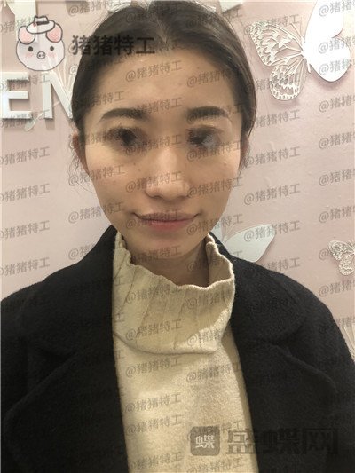 青岛诺德姜留刚面部填充案例价格分享,朋友认不出以为我是新来的模特?