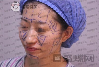 青岛诺德姜留刚面部填充案例价格分享,朋友认不出以为我是新来的模特?