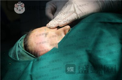 青岛诺德姜留刚面部填充案例价格分享,朋友认不出以为我是新来的模特?