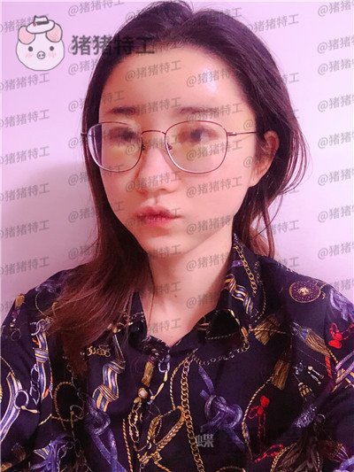 青岛诺德姜留刚面部填充案例价格分享,朋友认不出以为我是新来的模特?
