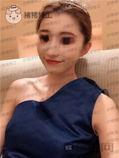 青岛诺德姜留刚面部填充案例价格分享,朋友认不出以为我是新来的模特?