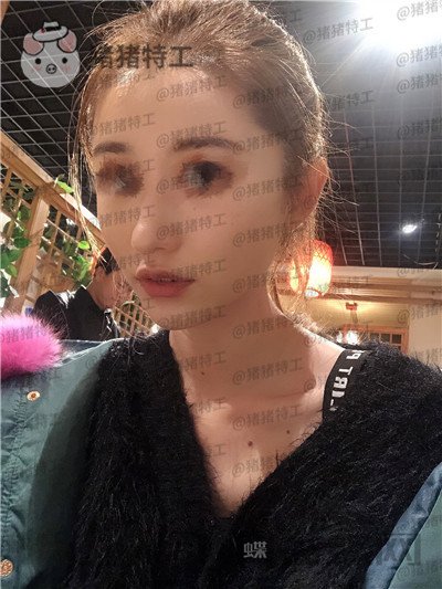 青岛诺德姜留刚面部填充案例价格分享,朋友认不出以为我是新来的模特?