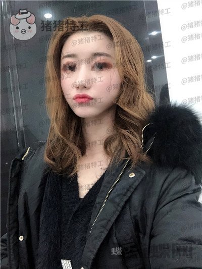 青岛诺德姜留刚面部填充案例价格分享,朋友认不出以为我是新来的模特?