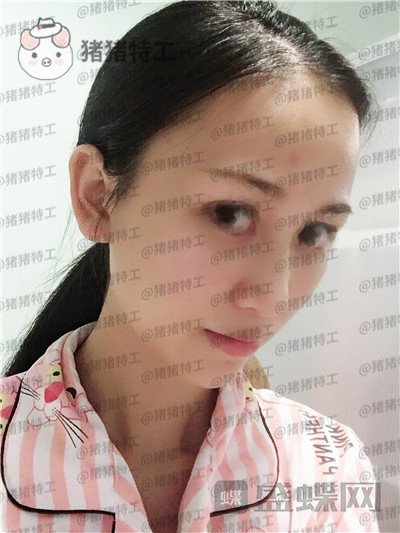 广州曙光蒋思军隆鼻案例价格分享,做完同事都夸我气质逼人异性缘飙升~