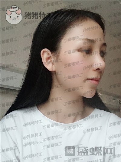 广州曙光蒋思军隆鼻案例价格分享,做完同事都夸我气质逼人异性缘飙升~