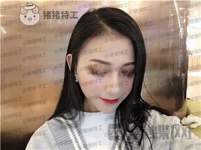 广州曙光蒋思军隆鼻案例价格分享,做完同事都夸我气质逼人异性缘飙升~