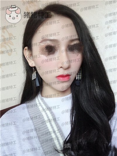 广州曙光蒋思军隆鼻案例价格分享,做完同事都夸我气质逼人异性缘飙升~