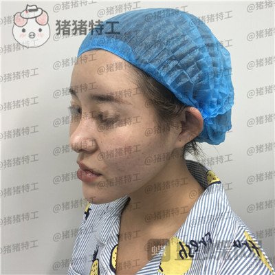 天津菲丝澜刘贝隆鼻案例价格分享,网红脸怎么了!我喜欢就好!