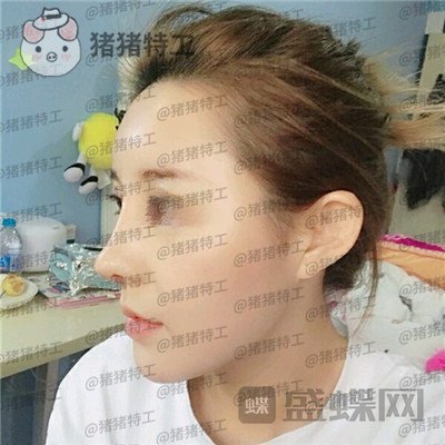 天津菲丝澜刘贝隆鼻案例价格分享,网红脸怎么了!我喜欢就好!