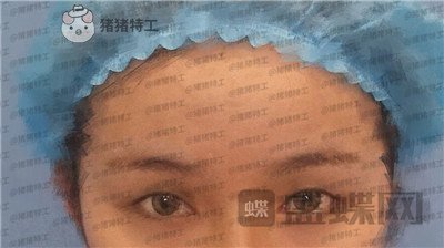 南京美贝尔黄名斗双眼皮案例价格分享,高级脸配备的双眼皮太女神了!