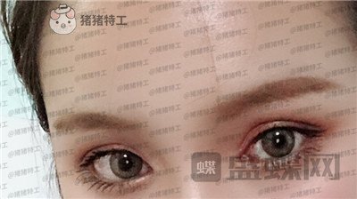 南京美贝尔黄名斗双眼皮案例价格分享,高级脸配备的双眼皮太女神了!