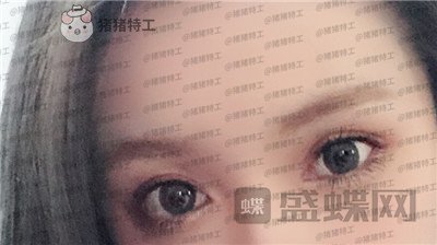 南京美贝尔黄名斗双眼皮案例价格分享,高级脸配备的双眼皮太女神了!