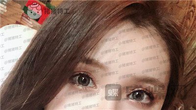 南京美贝尔黄名斗双眼皮案例价格分享,高级脸配备的双眼皮太女神了!