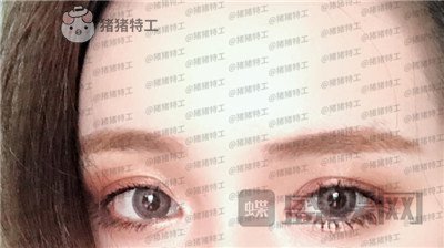 南京美贝尔黄名斗双眼皮案例价格分享,高级脸配备的双眼皮太女神了!