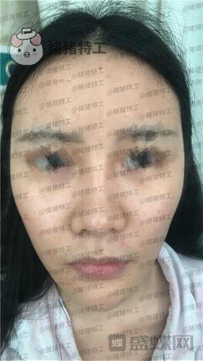 成都军大文科鼻部手术隆鼻案例价格分享,侧颜杀的女神正面同样很迷人~