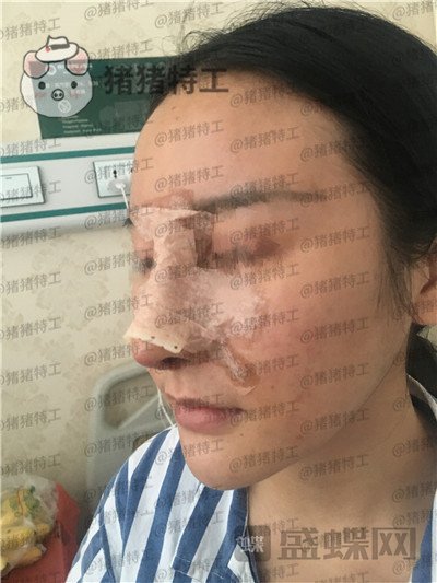 成都军大文科鼻部手术隆鼻案例价格分享,侧颜杀的女神正面同样很迷人~
