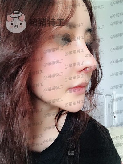 成都军大文科鼻部手术隆鼻案例价格分享,侧颜杀的女神正面同样很迷人~