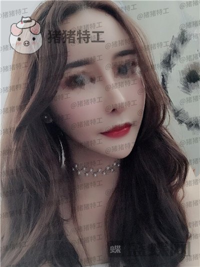 成都军大文科鼻部手术隆鼻案例价格分享,侧颜杀的女神正面同样很迷人~