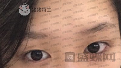 重庆美仑美奂董祥宁双眼皮案例价格分享,都说我单眼皮好看没想到双眼皮更美~